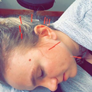 acupuncture